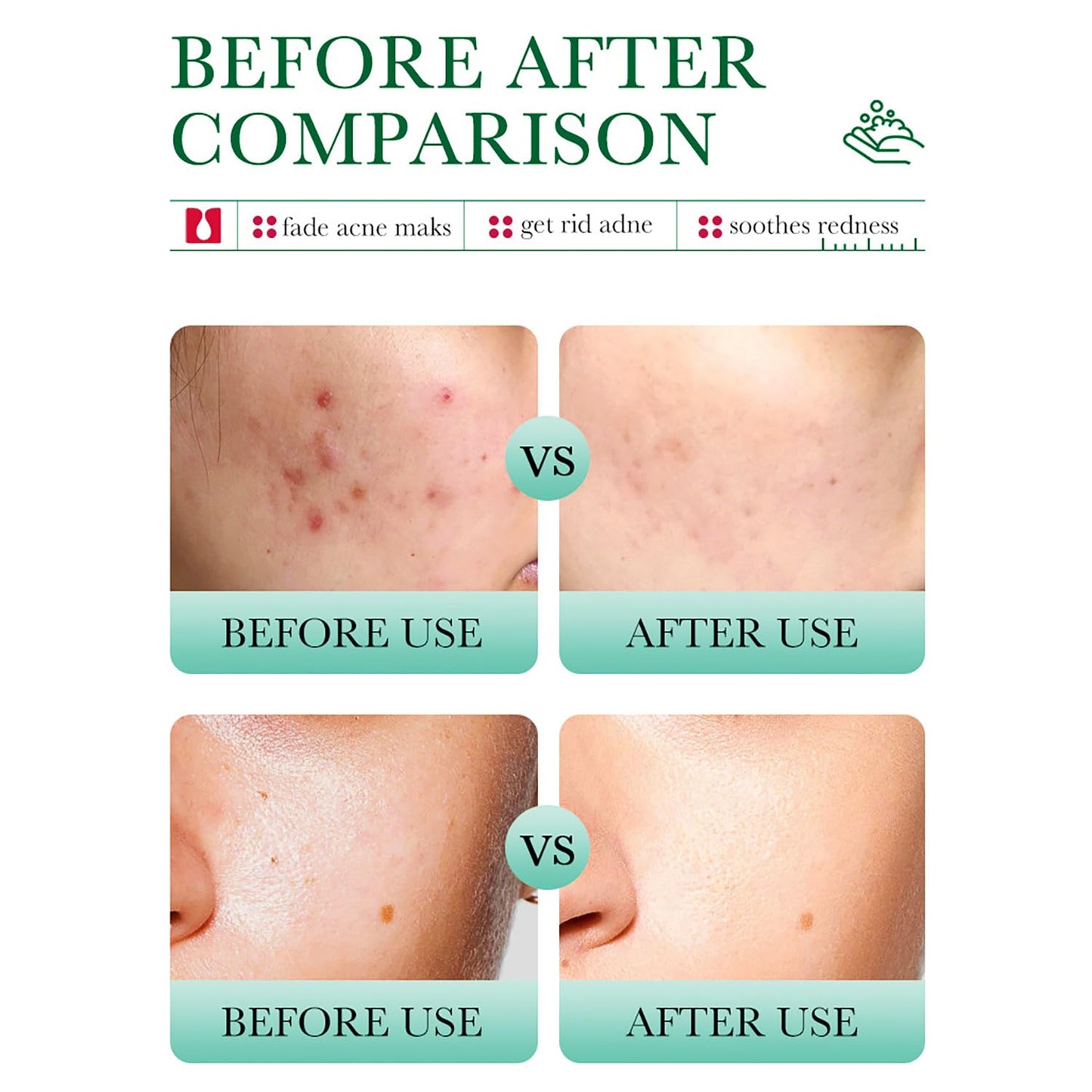 Bioaqua - Acne Removal & Anti Hair Loss